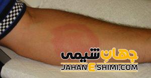 سیر تا پیاز حساسیت به پنی سیلین و راه های درمان آن