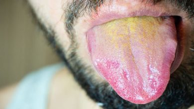مهم ترین دلایل زرد شدن زبان چیست؟ | دارو و درمان زرد شدن زبان