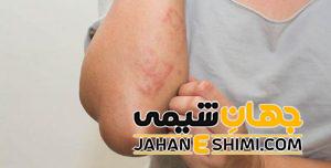 کهیر عصبی چیست؟ | دارو و درمان خانگی کهیر عصبی