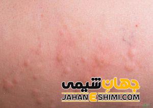سیر تا پیاز حساسیت به پنی سیلین و راه های درمان آن