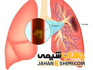 علائم و دلیل آمبولی ریه چیست؟ | دارو و درمان آمبولی ریه