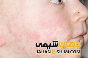 درمان فوری و معجزه آسای سرخک در کودکان