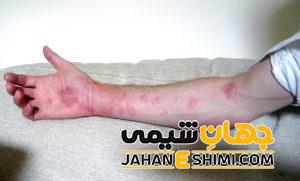 سیر تا پیاز حساسیت به پنی سیلین و راه های درمان آن