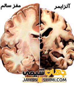 چگونه آلزایمر نگیریم؟ | دارو و درمان آلزایمر