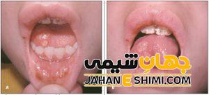 تبخال داخل دهان چگونه ایجاد می شود؟ | دارو و درمان تبخال داخل دهان