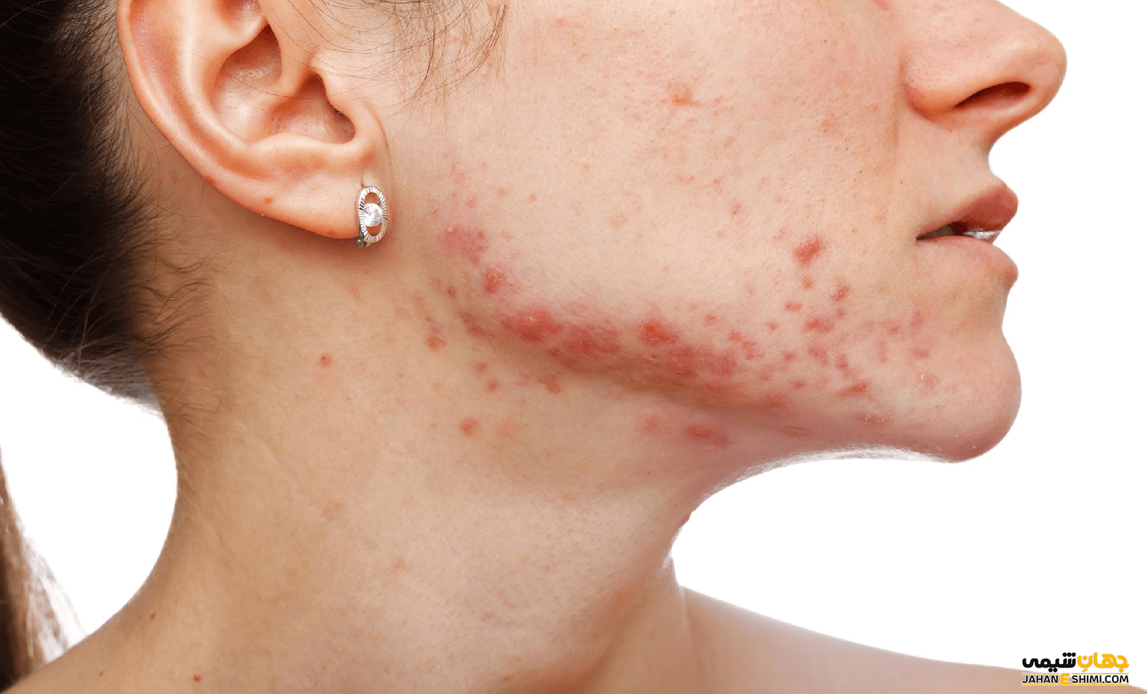 تجربه استفاده از بنزوئیل پروکساید چیست؟