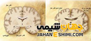 چگونه آلزایمر نگیریم؟ | دارو و درمان آلزایمر