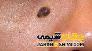 خال های قرمز، سیاه و سبز روی بدن نشانه چیست؟