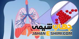 علائم و دلیل آمبولی ریه چیست؟ | دارو و درمان آمبولی ریه