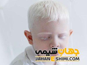 زالی یا آلبینیسم چیست؟ | دارو و درمان زالی