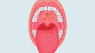تبخال داخل دهان چگونه ایجاد می شود؟ | دارو و درمان تبخال داخل دهان