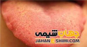مهم ترین دلایل زرد شدن زبان چیست؟ | دارو و درمان زرد شدن زبان