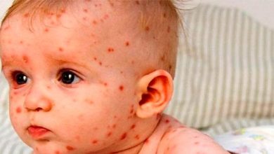 درمان فوری و معجزه آسای سرخک در کودکان