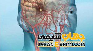 حمله ایسکمی گذرا چیست؟ | دارو و درمان حمله ایسکمی گذرا