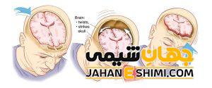 علائم ضربه مغزی چیست؟ | دارو و درمان ضربه مغزی