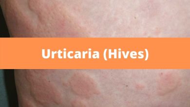 علت کهیر مزمن چیست| داروهای معجزه آسا برای درمان کهیر مزمن