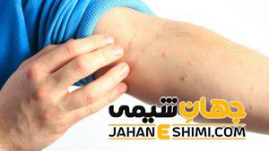 کهیر عصبی چیست؟ | دارو و درمان خانگی کهیر عصبی