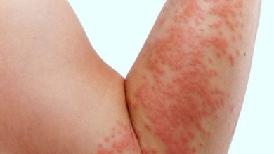 کهیر عصبی چیست؟ | دارو و درمان خانگی کهیر عصبی