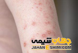 کهیر عصبی چیست؟ | دارو و درمان خانگی کهیر عصبی