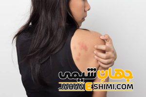 کهیر عصبی چیست؟ | دارو و درمان خانگی کهیر عصبی