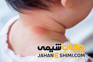 کهیر عصبی چیست؟ | دارو و درمان خانگی کهیر عصبی