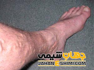 خیز یا ورم چیست؟ | دارو و درمان خیز یا ورم