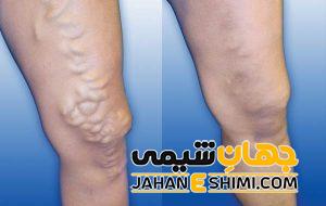 خیز یا ورم چیست؟ | دارو و درمان خیز یا ورم
