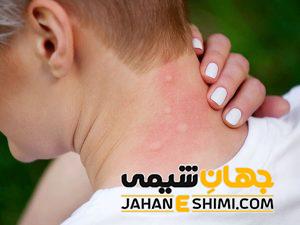 خارش پوست به چه علتی رخ می دهد؟ | 2 درمان شگفت انگیز درمان خارش پوست