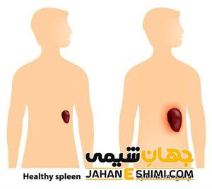 دلیل بزرگ شدن طحال چیست؟ | دارو و درمان بزرگ شدن طحال