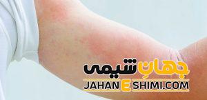 خارش پوست به چه علتی رخ می دهد؟ | 2 درمان شگفت انگیز درمان خارش پوست