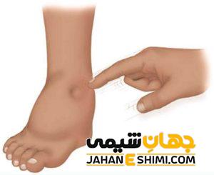 خیز یا ورم چیست؟ | دارو و درمان خیز یا ورم