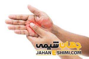 احساس سوزش در نقاط مختلف بدن به چه دلیل رخ می دهد؟ | دارو و درمان احساس سوزش
