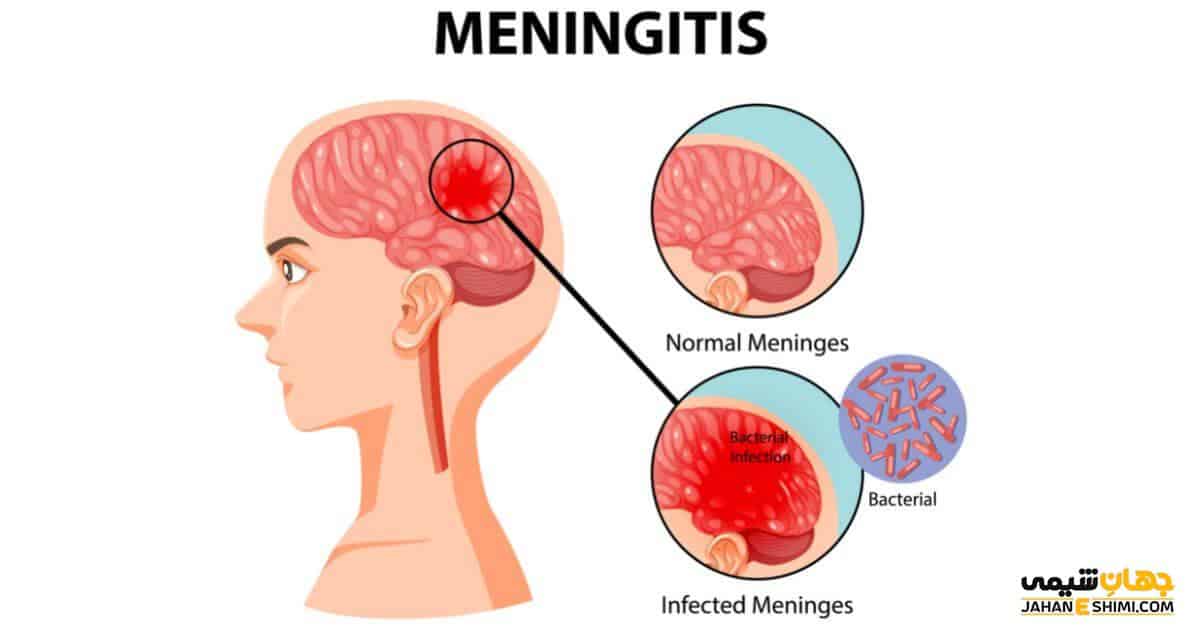 علت ابتلا به مننژیت چیست | معجزه درمان مننژیت در طب سنتی