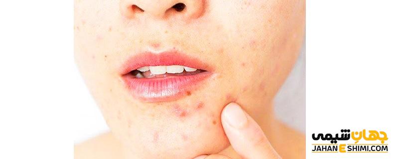روغن کرچک برای پوست
