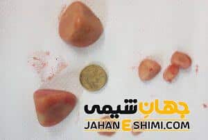 دفع سنگ از ادرار به چه دلیلی رخ می دهد؟ | دارو و درمان دفع سنگ از ادرار