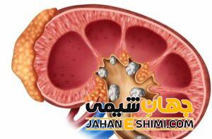 دفع سنگ از ادرار به چه دلیلی رخ می دهد؟ | دارو و درمان دفع سنگ از ادرار
