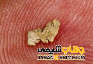 دفع سنگ از ادرار به چه دلیلی رخ می دهد؟ | دارو و درمان دفع سنگ از ادرار