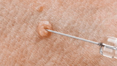 خطرات و علائم زگیل تناسلی در مردان چیست؟