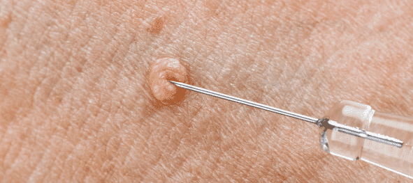 خطرات و علائم زگیل تناسلی در مردان چیست؟